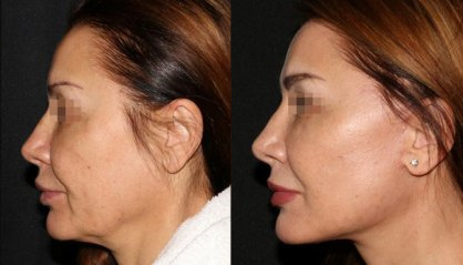 Sebelum dan sesudah facelifting