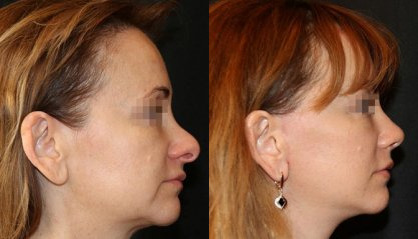 Rhinoplasty sebelum dan sesudah