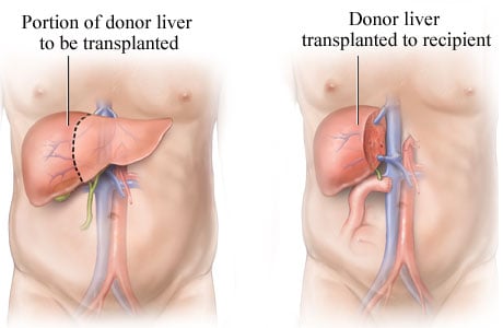 Proses transplantasi hati