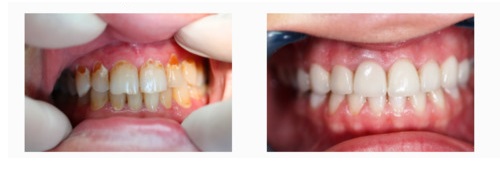 Veneer dipasang di Dental Dynastia 