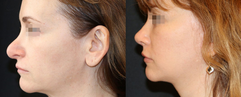 Pasien setelah rhinoplasty