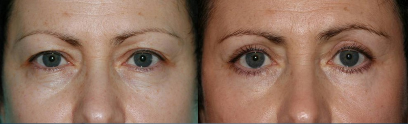 Pasien setelah blepharoplasty