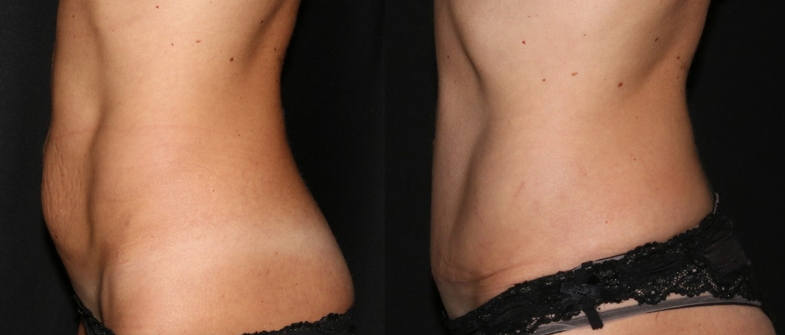 Pasien setelah abdominoplasti